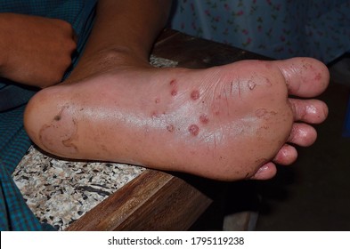 40 Monkeypox infestation Images, Stock Photos & Vectors | Shutterstock