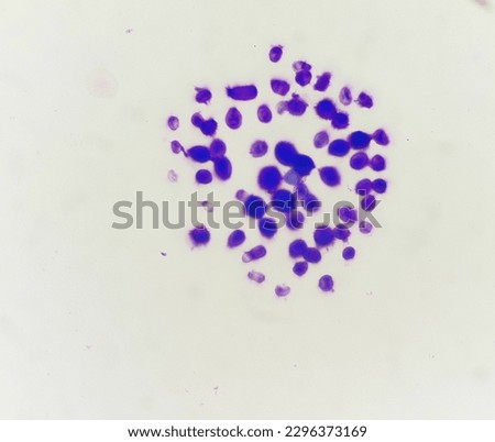 Cryptococcal meningitis in cerebrospinal fluid.