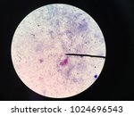 Cryptococcus from stool (oil) , mAFB