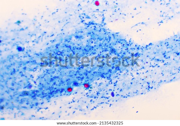 Cryptosporidium parvum protozoa positive (red\
sphere shape) in human stool smear, oocyst stage, acid-fast stain,\
analyze by\
microscope