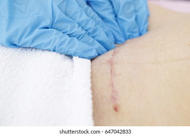 Varicose Veins Swelling Veins On Legs Stock Photo (Edit Now) 1168697086