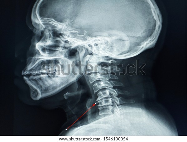 Cspine Lateral View Narrowing Disc Space Stock Photo (Edit Now) 1546100054