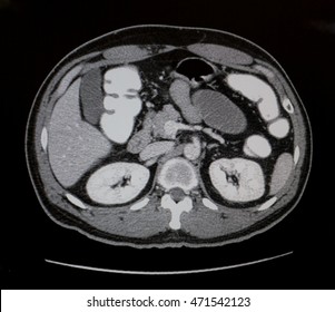 CT Abdomen Cross Section View