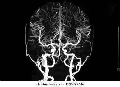 CT Angiography Of Brain