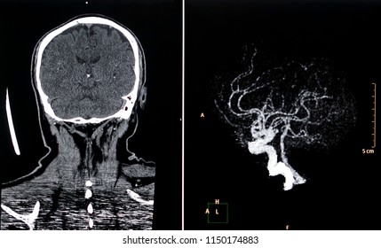  CT Angiography Of Brain                             