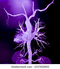 CT Angiography (Computed tomography angiography: CTA) of abdominal aorta, Rupture of an abdominal aortic aneurysm

