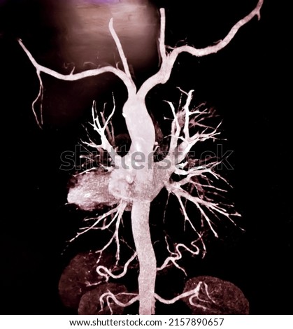 CT Angiography (Computed tomography angiography: CTA) of abdominal aorta, Rupture of an abdominal aortic aneurysm

