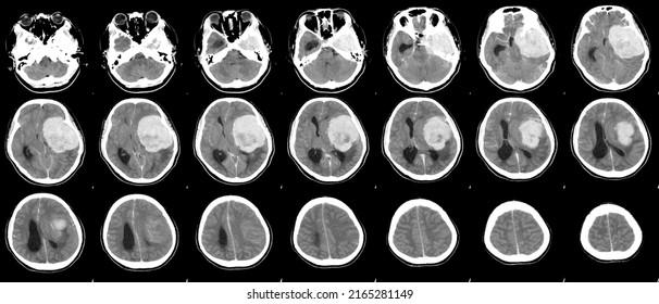 CT Brain History Headache Finding A 7 Cm. Extra-axial Mass With Stong Enhancement And Mass Effect To Left Cerebral Hemisphere,meningioma,Medical Image Concept.