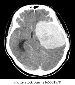 CT Brain History Headache Finding A 7 Cm. Extra-axial Mass With Stong Enhancement And Mass Effect To Left Cerebral Hemisphere,meningioma,Medical Image Concept.