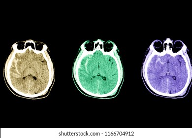 CT brain of a patient with traumatic brain injury showing subarachnoid hemorrhage 
