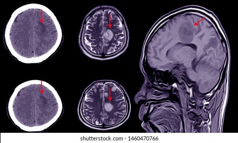 CT Brain Scan Of A Patient With History Of Mild Head Injury Showing Large Subacute Subdural Hematoma On Left Cerebral Hemisphere.Tone Color Process.