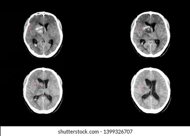 A CT Brain Scan Show A Metastatic Cancer Masses In The Right Thalamic And Basal Ganglionic Areas With Some Blood  In The Tumor Masses And The Right Ventricle.