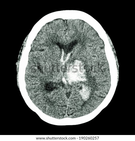 CT brain : show left thalamic hemorrhage (Hemorrhagic stroke)