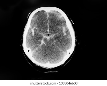 CT of the brain show subarachnoid hemorrhage