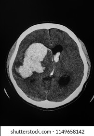 Ct Brain Showed Intracranial Hemorrhage With Intraventricular Hemorrhage