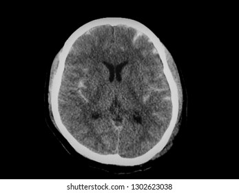 CT Brain Showed Traumatic Subarachnoid Hemorrhage