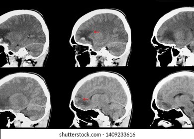 CT brian scan image of a recent traumatic brain injury patient showing brain contusion and hemorrhage at frontal load with subarachnoidal bleeding at the base of skull.