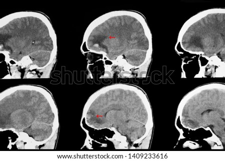 CT brian scan image of a recent traumatic brain injury patient showing brain contusion and hemorrhage at frontal load with subarachnoidal bleeding at the base of skull.