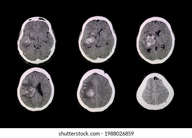 Basal Ganglia Hemorrhage Images Stock Photos Vectors Shutterstock