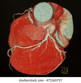 CT Cardiac 3D