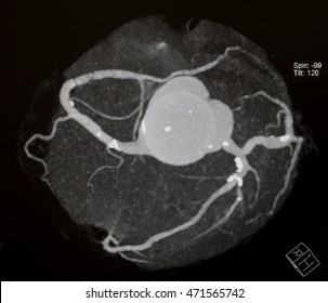 CT Cardiac Angiogragraphy