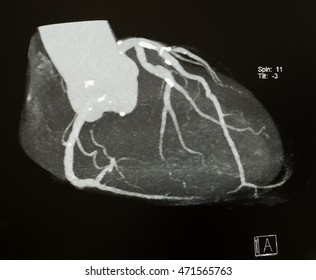 CT Cardiac Angiogragraphy