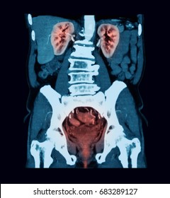 CT (Computed tomography) of urinary system, Urinary tract infection