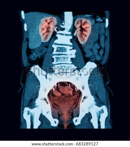 CT (Computed tomography) of urinary system, Urinary tract infection
