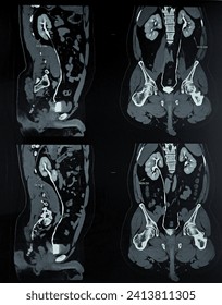 CT (computerized tomography) Urography, used to evaluate the urinary tract. medic and radiology concept. good for education. 