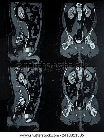CT (computerized tomography) Urography, used to evaluate the urinary tract. medic and radiology concept. good for education. 