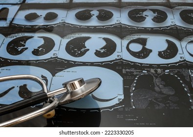 CT Image Of A Human Lung And A Phonendoscope, Checking For A Virus.Close-up