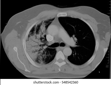 Ct Image Of Lung