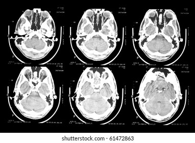 Ct Scan Of 30 Year Old Male Skull And Brain