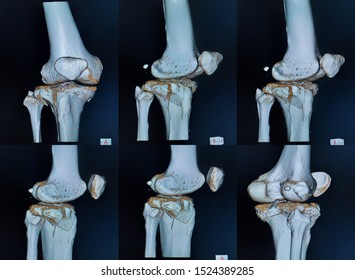 CT Scan And 3D Computer Rendering Image Of A Knee Of The Patient Periarticular Injuries Fracture Of The Proximal Tibia Frequently Associated With Soft Tissue Injuries.