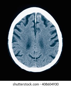 CT Scan 84 Year Old Male With Alzheimer's Disease. CT Shows Brain Atrophy With Small Gyri And Large Sulci