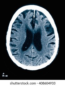 CT Scan 84 Year Old Male With Alzheimer's Disease. CT Shows Brain Atrophy With Small Gyri And Large Sulci