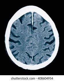 CT Scan 84 Year Old Male With Alzheimer's Disease. CT Shows Brain Atrophy With Small Gyri And Large Sulci