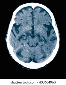 CT Scan 84 Year Old Male With Alzheimer's Disease. CT Shows Brain Atrophy With Small Gyri And Large Sulci