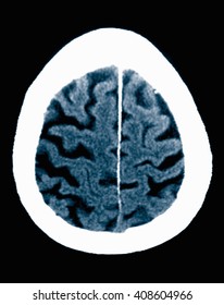 CT Scan 84 Year Old Male With Alzheimer's Disease. CT Shows Brain Atrophy With Small Gyri And Large Sulci