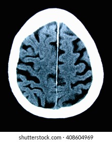 CT Scan 84 Year Old Male With Alzheimer's Disease. CT Shows Brain Atrophy With Small Gyri And Large Sulci