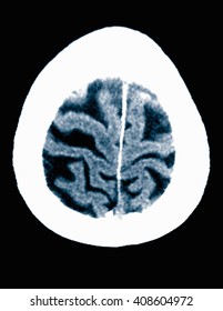 CT Scan 84 Year Old Male With Alzheimer's Disease. CT Shows Brain Atrophy With Small Gyri And Large Sulci