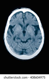 CT Scan 84 Year Old Male With Alzheimer's Disease. CT Shows Brain Atrophy With Small Gyri And Large Sulci