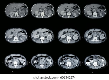 CT Scan Abdomen