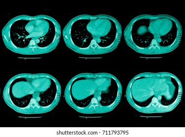 5,408 Stomach xray Images, Stock Photos & Vectors | Shutterstock