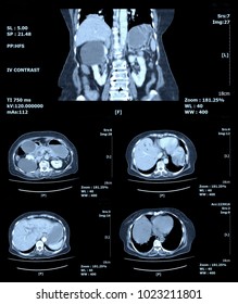 CT Scan Of Abdomen By Mri Scan Abdominal And Front Body.