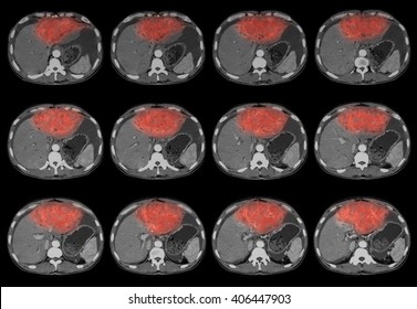 CT Scan Of Abdomen, A Case Of Liver Mass, Liver Abscess, Liver Abscess 