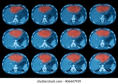 CT Scan Of Abdomen, A Case Of Liver Mass, Liver Abscess, Liver Abscess 