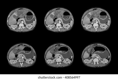 CT Scan Of Abdomen, A Case Of Liver Mass, Liver Abscesses