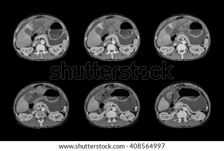 CT scan of abdomen, a case of liver mass, liver abscesses