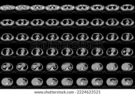 CT scan abdomen of the patient's Diffuse bronchial wall thickening and mild peribronchial infiltration at the superior segment of both lower lobes, Bone destruction at the vertebral body.
